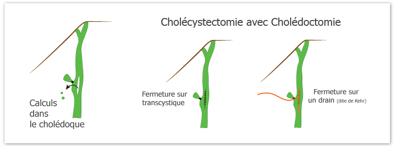 cholécystectomie