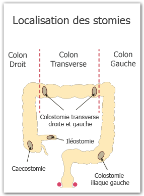 localisation des stomies