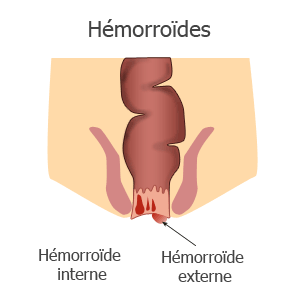 hemorroides et protocologie