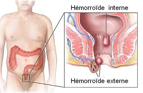 hemorrhoid