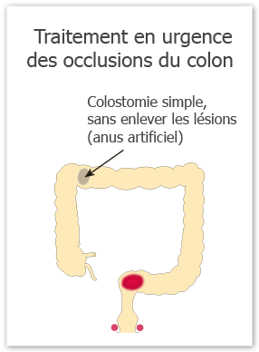 traitement en urgence des occlusions du colon