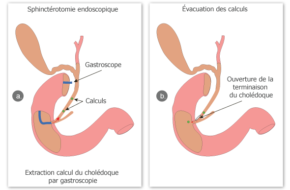 une sphinctérotomie endoscopique