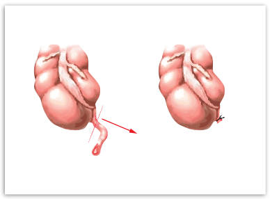 Appendicectomie - Chirurgie Viscerale Saint-Etienne