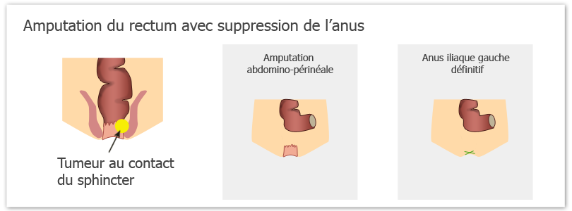 Résection du rectum avec suppréssion du sphincter anal