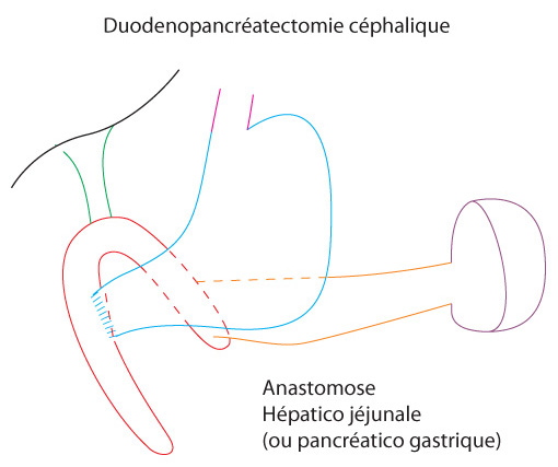 shema-duodenopancreatectomie